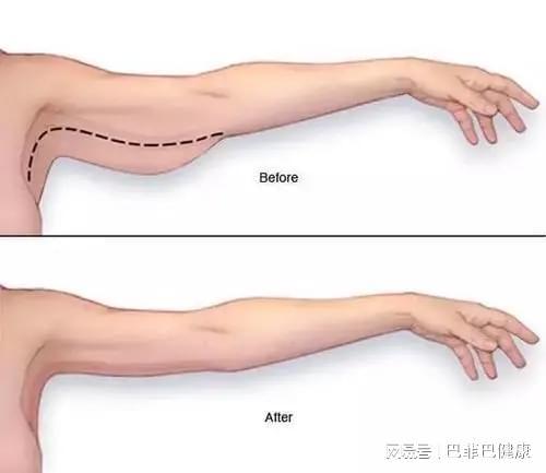 亿博体育官网入口app天鹅臂——多燕瘦打造纤细紧致手臂的秘诀(图4)